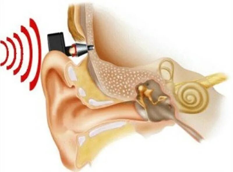 Костный слуховой аппарат неимплантируемый. Тугоухость кохлеарная имплантация. Слуховой аппарат костной проводимости Baha. Нейросенсорная тугоухость имплантация кохлеарная. Операция на ухо на слух