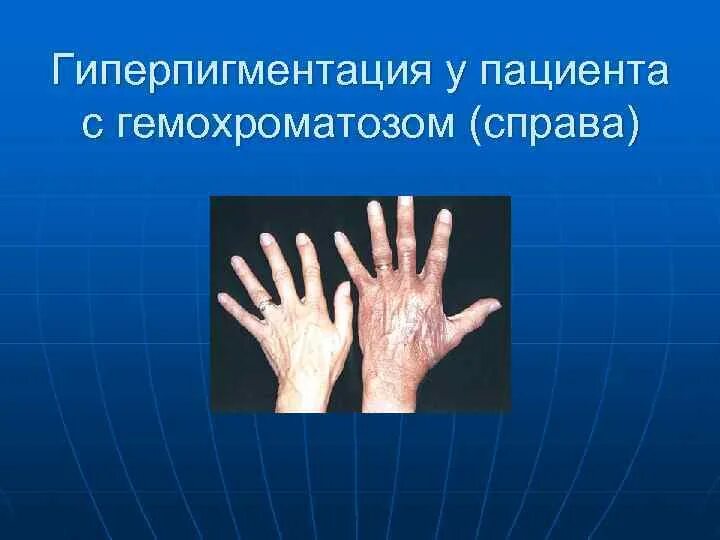 Без гемохроматозов