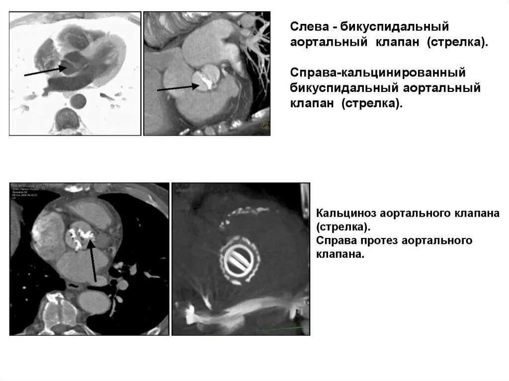 Двустворчатый аортальный клапан на кт. Кальциноз аортального клапана кт. Бикуспидальный аортальный клапан классификация. Бикуспидальный аортальный клапан типы.
