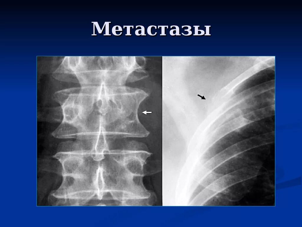 Метастазы по всему скелету. Метастазы в кости рентгенодиагностика. остеолитический метастаз в ребро. остеобластические очаги в ребрах.