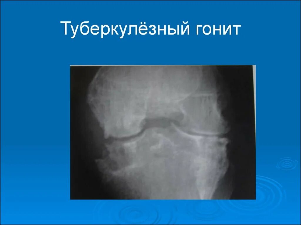 Туберкулез суставов рентген. Туберкулез коленного сустава рентген. Туберкулезный гонит рентгенограмма.