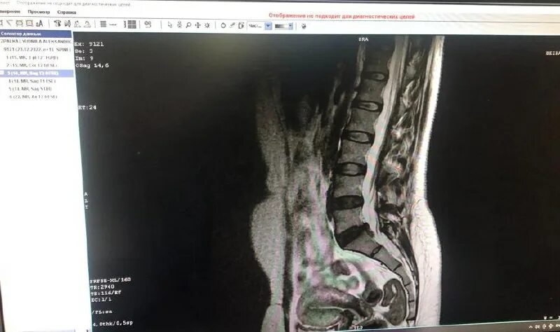 Кт с контрастом противопоказания. Мрт повторное через какое время. Мрт заключение малый таз. Мрт реклама. Ркт головного мозга заключение.