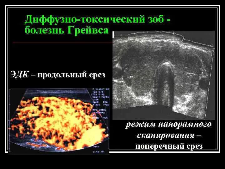 Диффузно токсический заболевание. ДТЗ на УЗИ щитовидной железы. Диффузный токсический зоб УЗИ. УЗИ при диффузном токсическом зобе. Диффузный зоб УЗИ протокол.