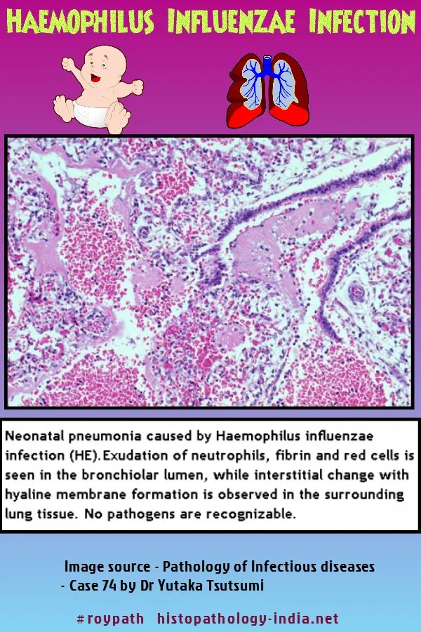 Haemophilus influenzae пневмония. Haemophilus parainfluenzae норма. Haemophilus influenzae норма. Haemophilus influenzae 10