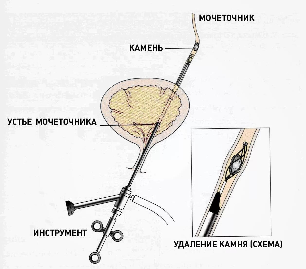 Как выводить камень из мочеточника. Контактная литотрипсия мочеточника. Лазерная контактная литотрипсия камня мочеточника. Контактная литотрипсия камней мочевого пузыря, мочеточника. Операция стент мочеточника.