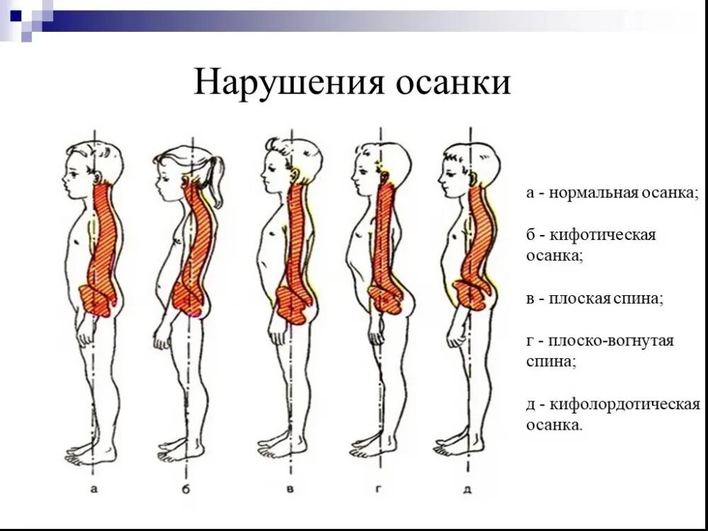 Кифотическая осанка схема. Классификация нарушений осанки. Типы осанки и причины. Типы осанки причины ее нарушения. Слабая поясница