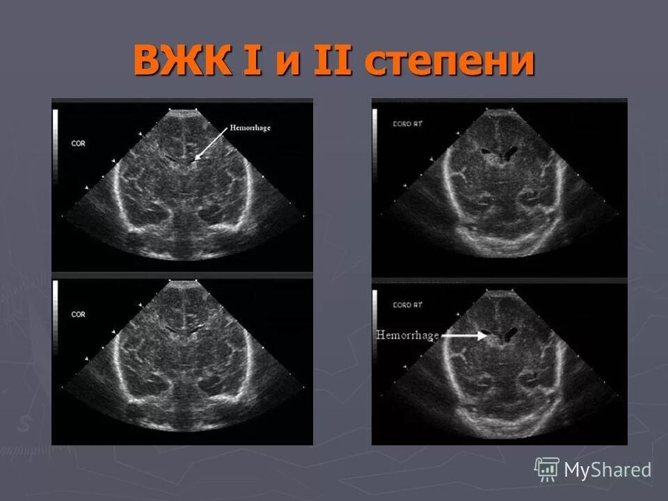 Внутрижелудочковое кровоизлияние