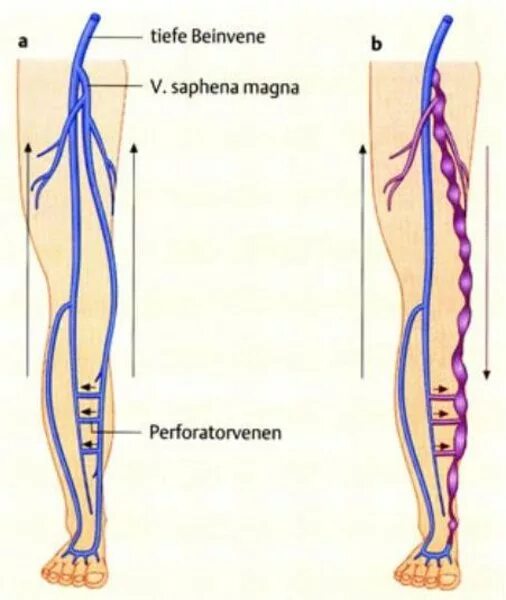 Vena saphena. Сафена Магна.