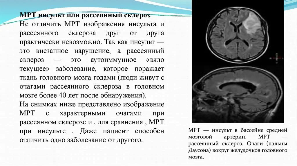 Склероз мозга. Инсульт в средней мозговой артерии клиника. Инсульт в бассейне средней мозговой артерии клиника. ОНМК В бассейне левой средней мозговой. Ишемический инсульт бассейна левой средней мозговой.