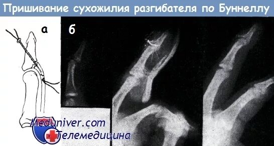 Разрыв разгибателя пальца мкб. Разрыв разгибателя пальца мкб