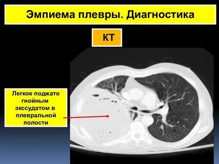 Эмпиема легкого