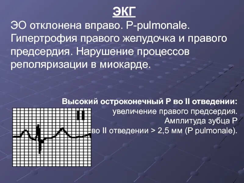 Отклонение оси сердца. Отклонение эос вправо. Резкое отклонение эос вправо на экг. Отклонение вправо на экг. Отклонение оси резко влево на экг.