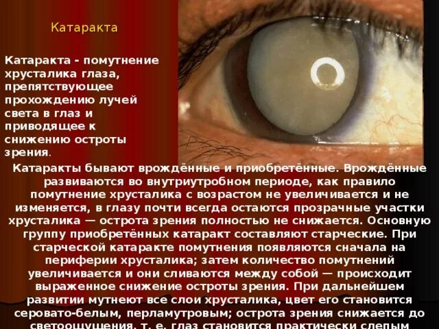 Острота зрения правый глаз левый глаз. Катаракта помутнение хрусталика. Врожденное помутнение хрусталика. Борьба с помутнением хрусталика катарактой.