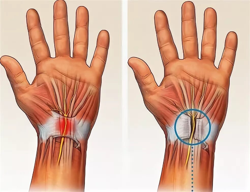 Операция карпального канала кисти. Синдром карпального канала операция. ЛФК синдром карпального канала. Синдром карпального канала кисти. Операция при синдроме карпального канала.