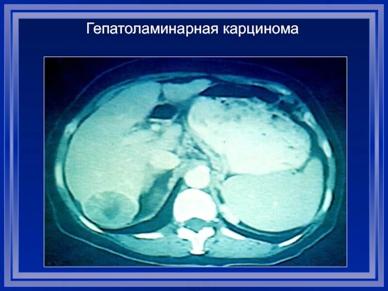 Округлые образования печени. Объемные образования печени. Дифференциальная диагностика объемных образований печени. Гиповаскулярное образование в печени на кт что это. Объемное образование печени s6 s7.