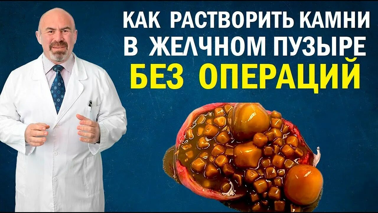 Камни в желчном пузыре отзывы пациентов. Растворение камней в желчном пузыре. Растворитель камней в желчном пузыре. Таблетки для растворения камней в желчном пузыре. Продукты для растворения камней в желчном пузыре.