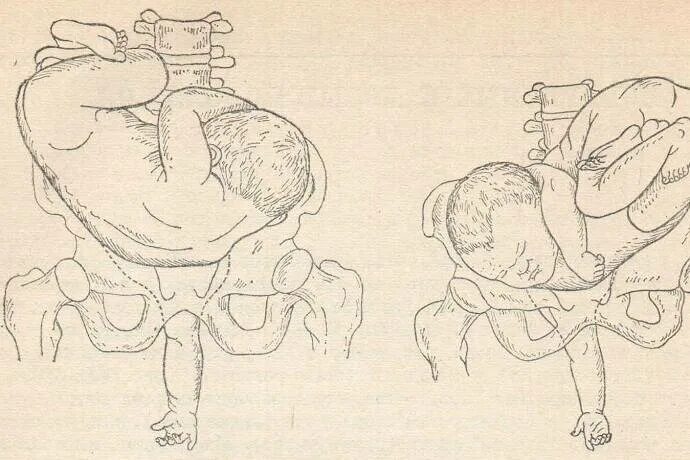 Тазовое предлежание мальчика. Косое тазовое предлежание плода. Гимнастика поперечного предлежания. Тазовое предлежание плода 1 позиция. Поперечное предлежание плода позиция 1 предлежание.