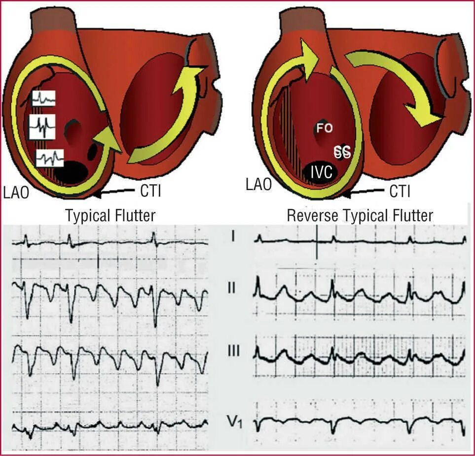 Сердце против часовой стрелки. Трепетание предсердий на ЭКГ. Трепетание предсердий классификация на ЭКГ. Типичное трепетание предсердий ЭКГ. Фибрилляция предсердий на ЭКГ.