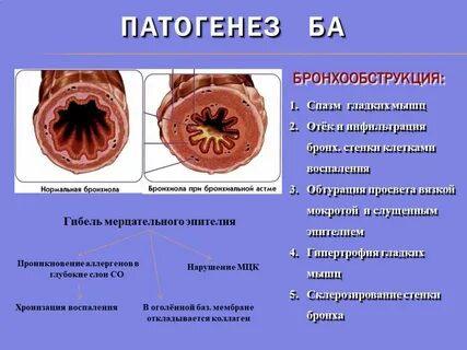 Бронхиальная мокрота