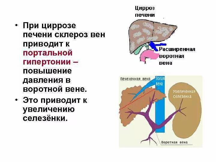 Печень расширены вены. Цирроз печени портальная гипертензия. Портальная Вена при циррозе печени. Воротная Вена при циррозе печени. Портальная гипертония цирроз печени.