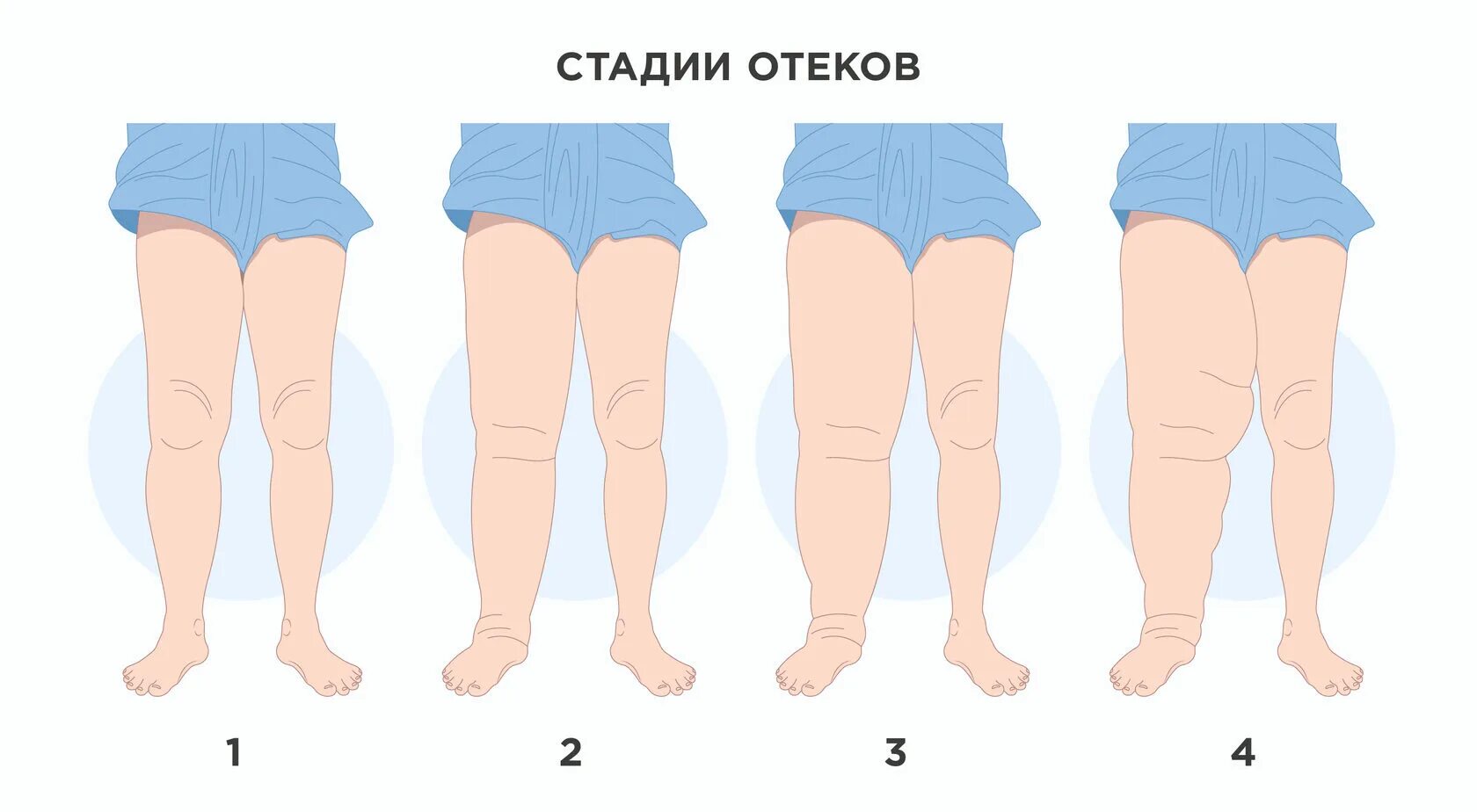 Стадии развития отеков беременных.