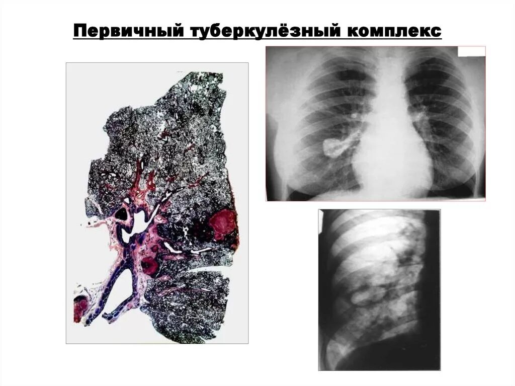 Врожденный туберкулез