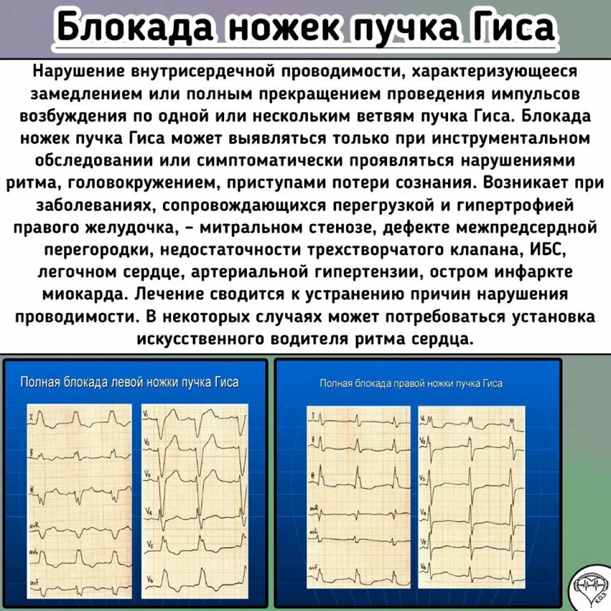 Полная блокада ножек гиса лечение. Блокада ножек и ветвей пучка Гиса. Блокада ЛНПГ И БПВЛНПГ. Нарушение проводимости по правой ножке пучка Гиса. Нарушение проводимости по ПНПГ.
