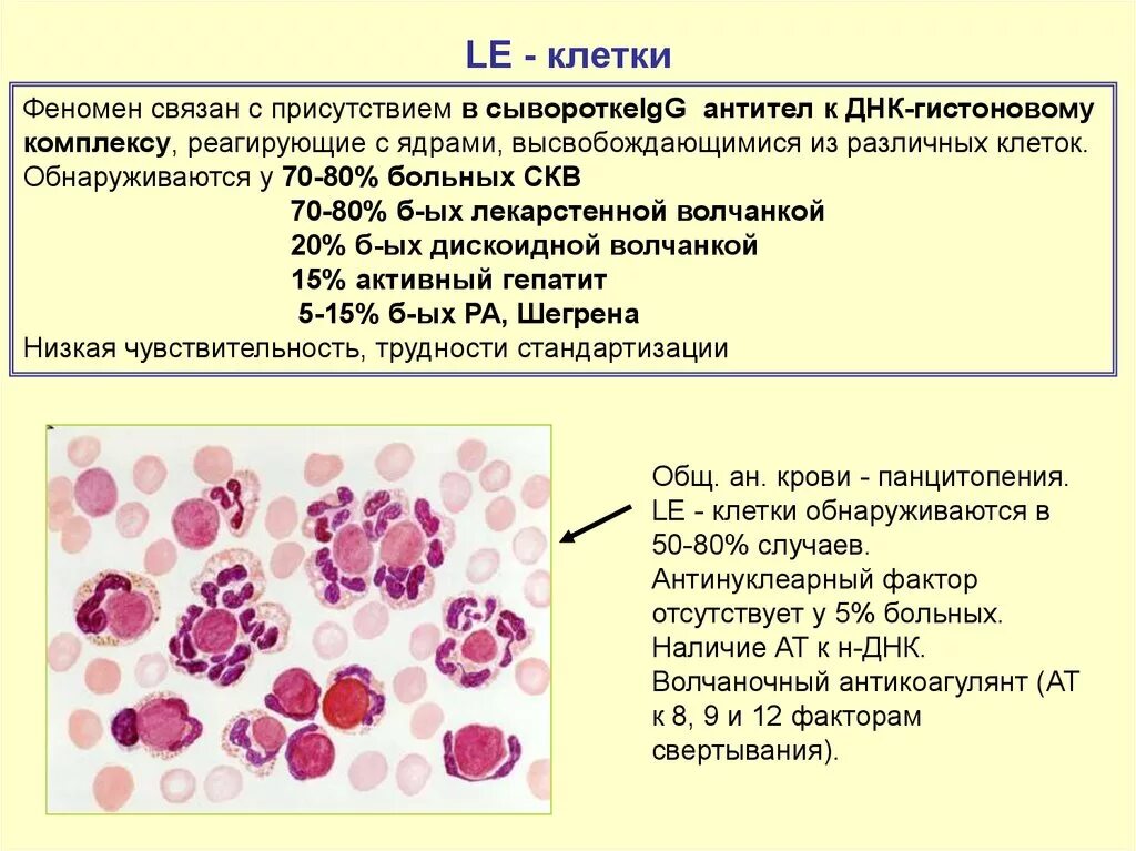 Le-клетки волчаночные клетки. Клетки при системной красной волчанке. Системная красная волчанка картина крови. Системная красная волчанка le клетки.