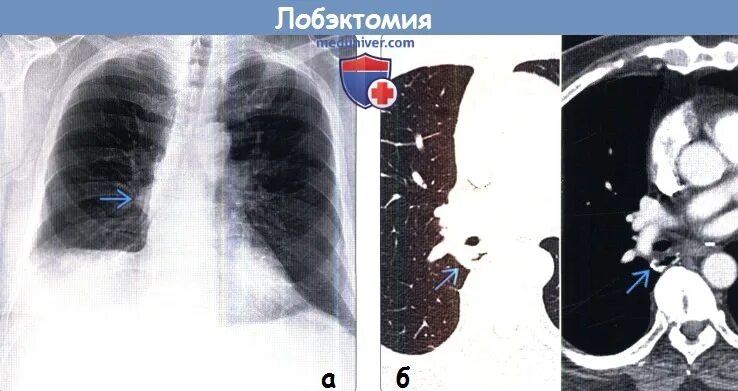 Лобэктомия верхней доли рентген. Средняя лобэктомия правого легкого. Лобэктомия верхней доли легкого. Лобэктомия верхней доли правого легкого операция. Лобэктомия что это