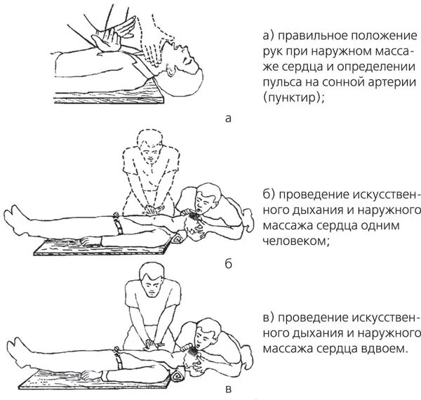 4. Проведение наружного массажа сердца. Проведение искусственного дыхания и непрямого массажа сердца. Непрямой массаж сердца алгоритм кратко. Порядок проведения непрямого наружного массажа сердца.