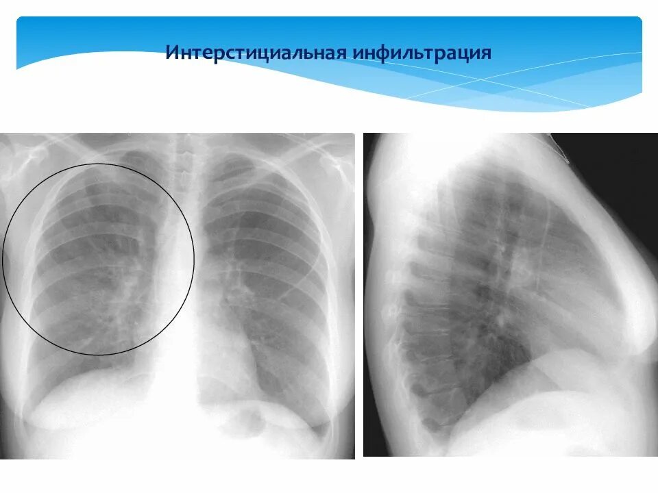 Округлый инфильтрат. Инфильтрация легочной ткани на рентгене при пневмонии. Очаговая пневмоническая инфильтрация. Казеозная пневмония инфильтрат. Интерстициальная пневмония на рентгенограмме.