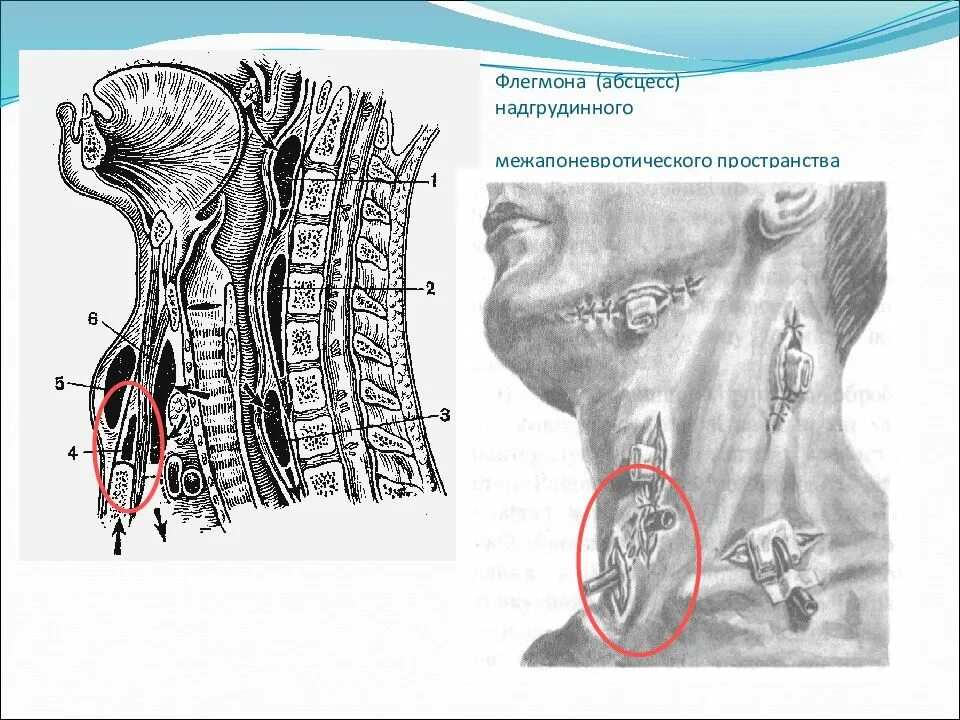 Оперативная хирургия шеи топографическая анатомия. Флегмона надгрудинное пространство. Абсцессы шеи топографическая анатомия. Флегмона надгрудинного клетчаточного пространства. Операция абсцесс шеи