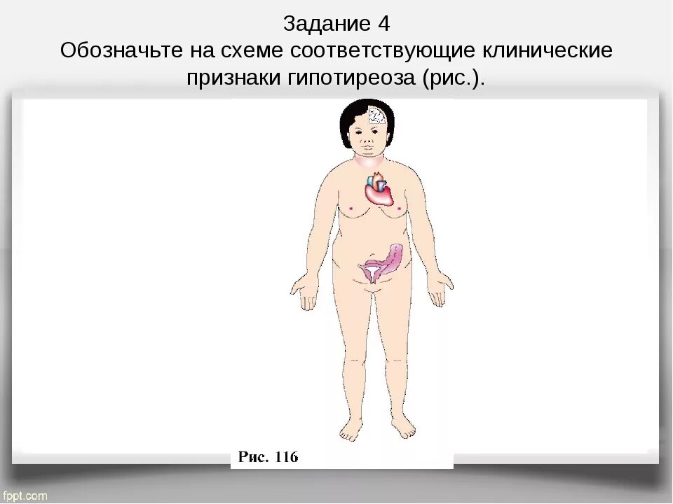 Клинические симптомы гипотиреоза. Клинические признаки гипотрериоза. Гипотиреоз как выглядит человек.