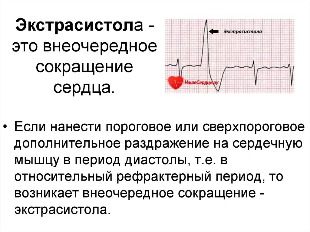 Экстрасистолы что это такое простыми