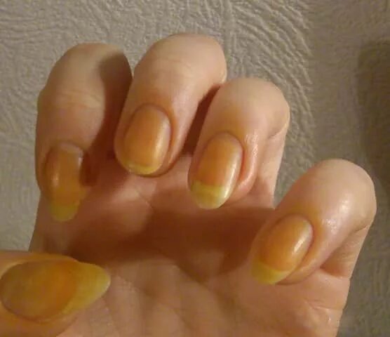 Нанесение йода на ногти. Йод для роста ногтей. Мазать ногти йодом на ночь. Йод для укрепления ногтевой пластины. Зачем мазать ногти йодом.