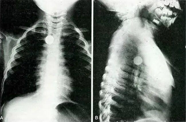 Тело пищевода. Инородное тело в трахее рентген. Инородное тело пищевода рентген. Инородные тела пищевода у детей. Инородное тело в бронхах рентген.