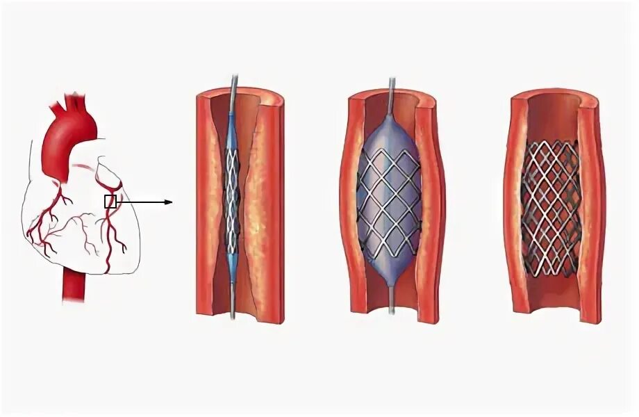 Санаторий после стентирования. Шунтирование сосудов сердца стент. Шунтирование сердца и стентирование. Операция стентирование сосудов сердца. Шунтирование и стентирование сосудов сердца в чем разница.