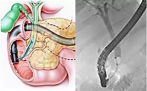 Стентирование панкреатического протока. Эндоскопическое стентирование желчных протоков. Стентирование вирсунгова протока. Стент желчного протока