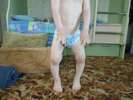 Варусные голени у детей