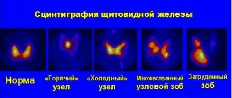 Узловой токсический зоб сцинтиграфия. Радиоизотопный метод исследования щитовидной железы. Радионуклидное сканирование щитовидной железы. Токсическая аденома сцинтиграфия.