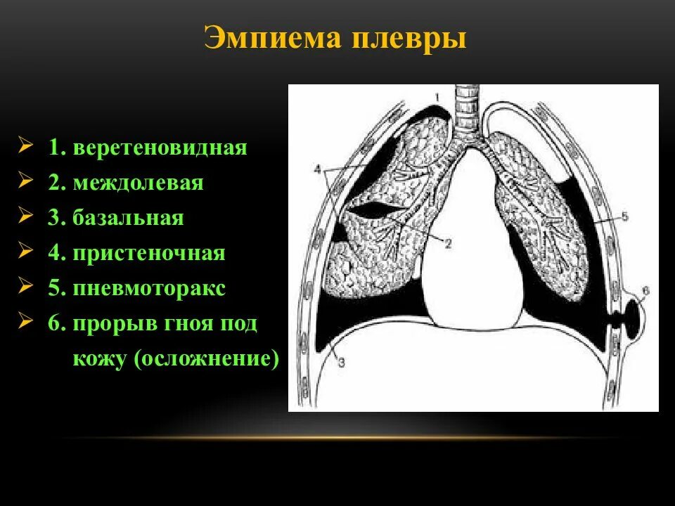 Гнойный плеврит (эмпиема). Плевральный выпот и эмпиема это. Эмпиема легких рентген. Эмпиема плевры, пиоторакс.. Эмпиема легкого