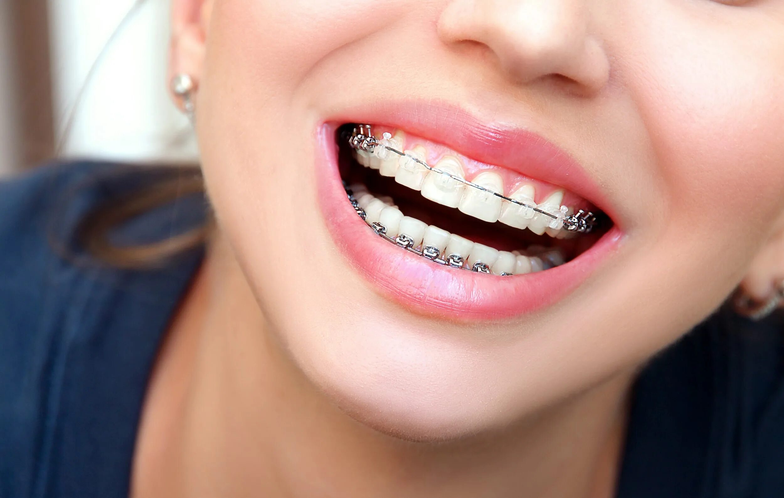 Brackets photo