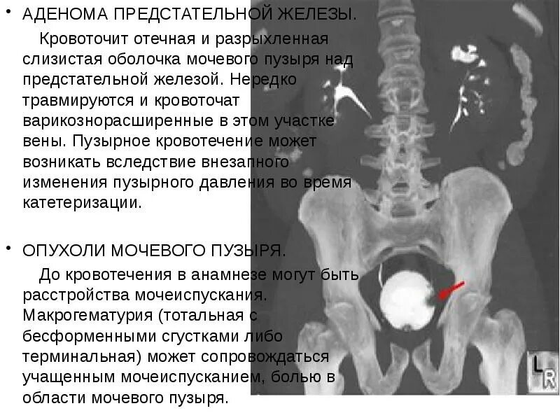 Боли предстательной железы у мужчин. Доброкачественная гиперплазия предстательной железы. Аденома характеристика. Слизистая оболочка предстательной железы.