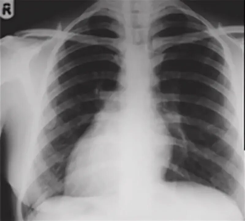 Экг при декстрокардии наложение электродов. Правостороннее расположение сердца. Декстрокардия является проявлением. Правостороннее расположение сердца. Декстрокардия классификация.