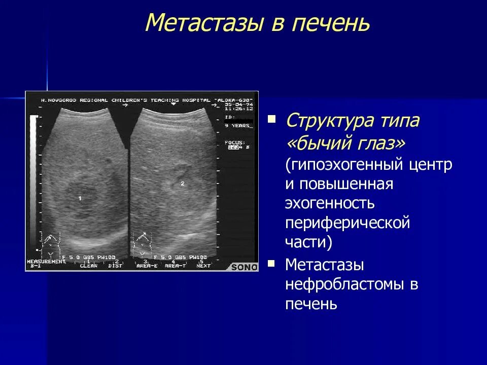 Метастазы в печень мкб. Метастатическое поражение печени УЗИ. Метастазы в печени типа бычий глаз. Метастазы в печени по УЗИ.