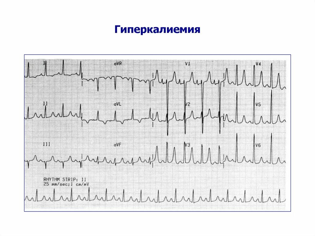 Гиперкалиемия что. Гипокалиемия и гиперкалиемия на ЭКГ. Клинические симптомы гиперкалиемии. ЭКГ при гипокалиемии и гиперкалиемии. Изменения на ЭКГ при гиперкалиемии.