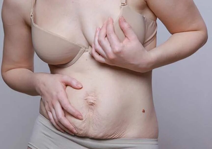 Живот рожавшей женщины. Живот рожавшей женщины. Растяжки при беременности. Живот беременной с растяжками. Живот рожавшей женщины.