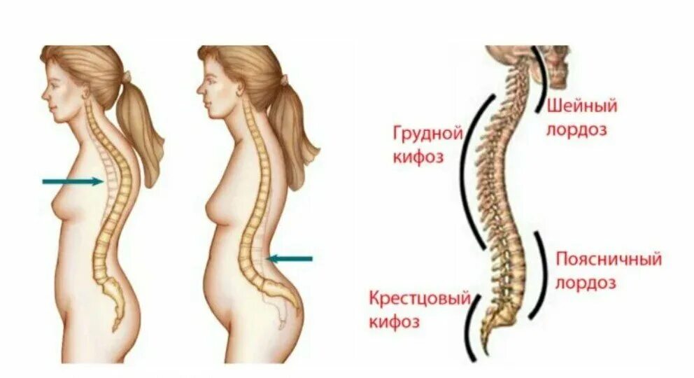 Шейный лордоз кифоз. Лордоз позвоночника сглажен что. Лордоз грудного отдела позвоночника. Искривление позвоночника кифоз и лордоз.