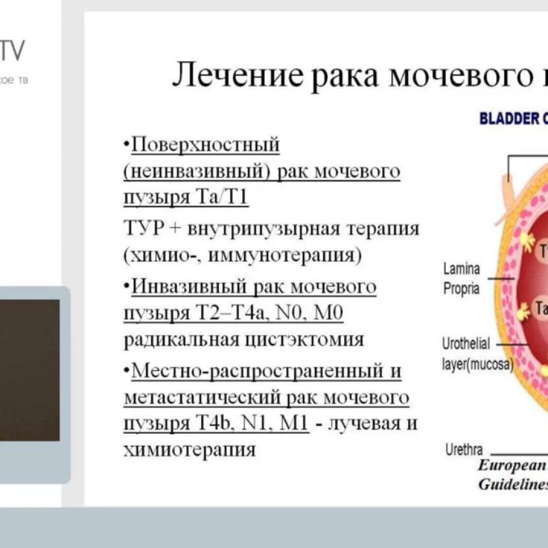 Сколько лечится рак. Опухоль мочевого пузыря. Раковая опухоль мочевого пузыря. Злокачественная опухоль мочевого пузыря. Локализация опухоли мочевого пузыря.