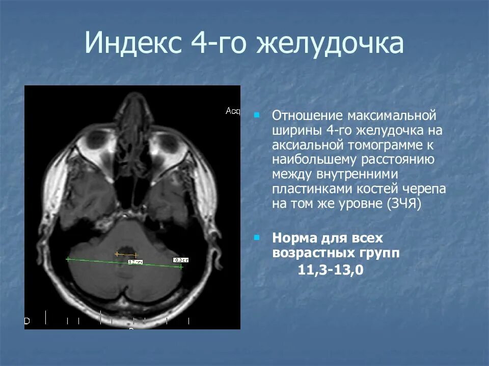 Норма желудочков мозга у взрослых. 4 Желудочек головного мозга кт. Размер 4 желудочка головного мозга. 4 Желудочек головного мозга анатомия мрт. Желудочки головного мозга кт анатомия.